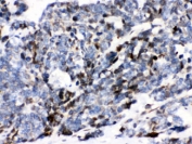 IHC testing of FFPE human lung cancer with ATXN1 antibody. HIER: Boil the paraffin sections in pH 6, 10mM citrate buffer for 20 minutes and allow to cool prior to staining.