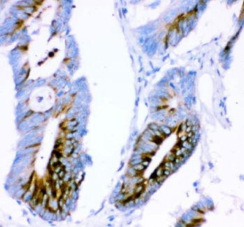 IHC staining of FFPE human colon cancer tissue with ATXN1 antibody. HIER: boil tissue sections in pH8 EDTA for 20 min and allow to cool before testing.