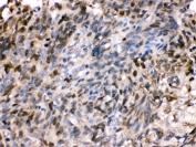 IHC testing of FFPE human lung cancer tissue with HSPA2 antibody. HIER: Boil the paraffin sections in pH 6, 10mM citrate buffer for 20 minutes and allow to cool prior to staining.