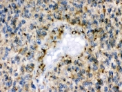 IHC testing of FFPE human glioma tissue with EPHB1 antibody. HIER: Boil the paraffin sections in pH 6, 10mM citrate buffer for 20 minutes and allow to cool prior to staining.