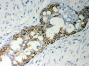 IHC testing of FFPE human breast cancer and Caspase-7 antibody. HIER: Boil the paraffin sections in pH 6, 10mM citrate buffer for 20 minutes and allow to cool prior to staining.