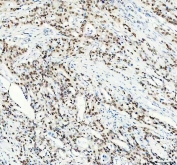 IHC staining of FFPE human pancreatic cancer tissue with FOXA3 antibody. HIER: boil tissue sections in pH8 EDTA for 20 min and allow to cool before testing.