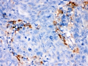IHC testing of FFPE human lung cancer tissue with FCGRT antibody. HIER: Boil the paraffin sections in pH 6, 10mM citrate buffer for 20 minutes and allow to cool prior to staining.