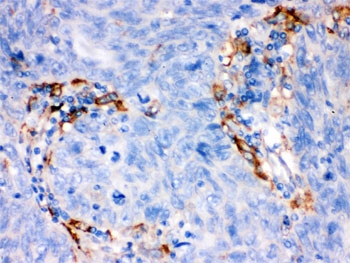 IHC testing of FFPE human lung cancer tissue with FCGRT antibody. HIER: Boil the paraffin sections in pH 6, 10mM citrate buffer for 20