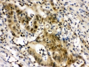 IHC testing of FFPE human intestinal cancer tissue with Eukaryotic Translation Initiation Factor 6 antibody. HIER: Boil the paraffin sections in pH 6, 10mM citrate buffer for 20 minutes and allow to cool prior to staining.