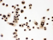 IHC testing of FFPE human SW480 cells with Eukaryotic Translation Initiation Factor 6 antibody. HIER: Boil the paraffin sections in pH 6, 10mM citrate buffer for 20 minutes and allow to cool prior to staining.