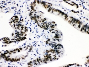 IHC testing of FFPE human intestinal cancer with CTBP2 antibody. HIER: Boil the paraffin sections in pH 6, 10mM citrate buffer for 20 minutes and allow to cool prior to staining.