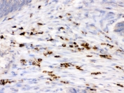 IHC testing of FFPE human intestinal cancer with Lysozyme antibody. HIER: Boil the paraffin sections in pH 6, 10mM citrate buffer for 20 minutes and allow to cool prior to staining.