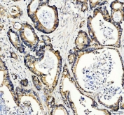 IHC staining of FFPE human colon cancer tissue with RAC1 antibody. HIER: boil tissue sections in pH8 EDTA for 20 min and allow to cool before testing.