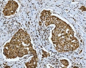 IHC staining of FFPE human breast cancer tissue with SNRPN antibody. HIER: boil tissue sections in pH8 EDTA for 20 min and allow to cool before testing.