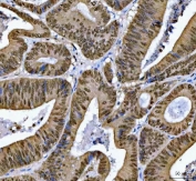 IHC staining of FFPE human colorectal adenocarcinoma tissue with SNRPN antibody. HIER: boil tissue sections in pH8 EDTA for 20 min and allow to cool before testing.
