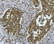 IHC staining of FFPE human ovarian serous adenocarcinoma tissue with SNRPN antibody. HIER: boil tissue sections in pH8 EDTA for 20 min and allow to cool before testing.