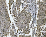 IHC staining of FFPE human cervical cancer tissue with SNRPN antibody. HIER: boil tissue sections in pH8 EDTA for 20 min and allow to cool before testing.