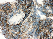 IHC testing of FFPE human lung cancer tissue with YB1 antibody. HIER: Boil the paraffin sections in pH 6, 10mM citrate buffer for 20 minutes and allow to cool prior to staining.