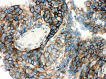 IHC testing of FFPE human lung cancer tissue with YB1 antibody. HIER: Boil the paraffin sections in pH 6, 10mM citrate buffer for 20 minutes and allow to cool prior to staining.