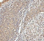 IHC staining of FFPE human breast cancer tissue with anti-Actin antibody. HIER: boil tissue sections in pH8 EDTA for 20 min and allow to cool before testing.