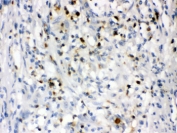 IHC testing of FFPE human intestinal cancer tissue with NGAL antibody. HIER: Boil the paraffin sections in pH 6, 10mM citrate buffer for 20 minutes and allow to cool prior to staining.