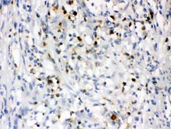 IHC testing of FFPE human intestinal cancer tissue with NGAL antibody. HIER: Boil the paraffin sections in pH 6, 10m