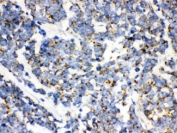 IHC testing of FFPE human lung cancer with mtTFA antibody. HIER: Boil the paraffin sections in pH 6, 10mM citrate buffer for 20 minutes and allow to cool prior to staining.