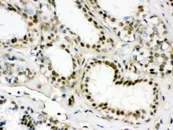 IHC testing of FFPE human breast cancer tissue with EWSR1 antibody. HIER: Boil the paraffin sections in pH 6, 10mM citrate buffer for 20 minutes and allow to cool prior to staining.
