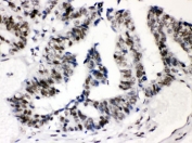 IHC testing of FFPE human intestinal cancer wtih SP3 antibody. HIER: Boil the paraffin sections in pH 6, 10mM citrate buffer for 20 minutes and allow to cool prior to staining.