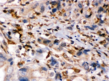 IHC testing of FFPE human intestinal cancer tissue with TAP1 antibody. HIER: Boil the paraffin sections in pH 6
