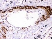 IHC testing of FFPE human lung cancer with SHP-2 antibody. HIER: Boil the paraffin sections in pH 6, 10mM citrate buffer for 20 minutes and allow to cool prior to staining.