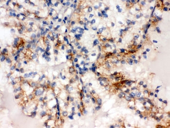 IHC testing of FFPE human renal cancer tissue with SULT2A1 antibody. HIER: Boil the paraffin sections in pH 6, 10mM citrate buffer for 20 minutes and allow to cool prior to staining.