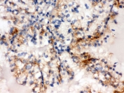 IHC testing of FFPE human renal cancer tissue with SULT2A1 antibody. HIER: Boil the paraffin sections in pH8 EDTA buffer for 20 minutes and allow to cool prior to staining.