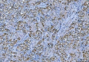 IHC staining of FFPE human testicular seminoma tissue with FMRP antibody. HIER: boil tissue sections in pH8 EDTA for 20 min and allow to cool before testing.