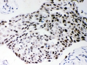 IHC testing of FFPE human breast cancer with SF2 antibody. HIER: Boil the paraffin sections in pH 6, 10mM citrate buffer for 20 minutes and allow to cool prior to staining.