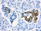 IHC testing of FFPE human pancreatic cancer tissue with CYP24A1 antibody. HIER: Boil the paraffin sections in pH 6, 10mM citrate buffer for 20 minutes and allow to cool prior to staining.