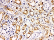 IHC testing of FFPE human prostate cancer tissue with LOXL1 antibody. HIER: Boil the paraffin sections in pH 6, 10mM citrate buffer for 20 minutes and allow to cool prior to staining.
