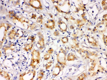 IHC testing of FFPE human prostate cancer tissue with LOXL1 antibody. HIER: Boil the paraffin sections in pH 6, 10mM citrate