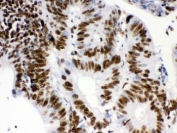 IHC testing of FFPE human intestinal cancer tissue with RBBP4 antibody. HIER: Boil the paraffin sections in pH 6, 10mM citrate buffer for 20 minutes and allow to cool prior to staining.