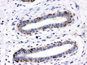 IHC testing of FFPE human breast cancer tissue with ASPH antibody. HIER: Boil the paraffin sections in pH 6, 10mM citrate buffer for 20 minutes and allow to cool prior to staining.