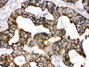IHC testing of FFPE human intestinal cancer tissue with TRAP1 antibody. HIER: Boil the paraffin sections in pH 6, 10mM citrate buffer for 20 minutes and allow to cool prior to staining.
