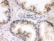 IHC testing of FFPE human prostate cancer tissue with SAP97 antibody. HIER: Boil the paraffin sections in pH 6, 10mM citrate buffer for 20 minutes and allow to cool prior to staining.