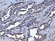 IHC testing of FFPE human ovarian cancer tissue with TRIM28 antibody. HIER: Boil the paraffin sections in pH8 EDTA buffer for 20 minutes and allow to cool prior to staining.