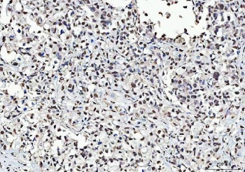 IHC testing of FFPE human gastric carcinoma tissue with TRIM28 antibody. HIER: Boil the paraffin sections in pH8 EDTA buffer for 20 minutes and allow to cool prior to staining.
