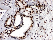 IHC testing of FFPE human breast cancer tissue with TRIM28 antibody. HIER: Boil the paraffin sections in pH8 EDTA buffer for 20 minutes and allow to cool prior to staining.