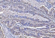 IHC testing of FFPE human colorectal adenocarcinoma tissue with TRIM28 antibody. HIER: Boil the paraffin sections in pH8 EDTA buffer for 20 minutes and allow to cool prior to staining.