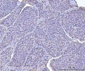 IHC testing of FFPE human liver cancer tissue with TRIM28 antibody. HIER: Boil the paraffin sections in pH8 EDTA buffer for 20 minutes and allow to cool prior to staining.