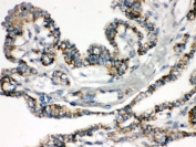 IHC testing of FFPE human thyroid cancer tissue with BIK antibody. HIER: Boil the paraffin sections in pH 6, 10mM citrate buffer for 20 minutes and allow to cool prior to staining.