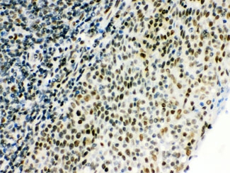 IHC testing of FFPE human tonsil tissue with CTBP1 antibody. HIER: Boil the paraffin sections in pH 6, 10mM citrate buffer for 20 minutes and allow to cool prior to staining.