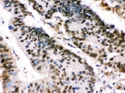 IHC testing of FFPE human intestinal cancer tissue with XRCC4 antibody. HIER: Boil the paraffin sections in pH 6, 10mM citrate buffer for 20 minutes and allow to cool prior to staining.