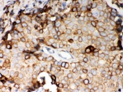 IHC testing of FFPE human breast cancer with STIM1 antibody. HIER: Boil the paraffin sections in pH 6, 10mM citrate buffer for 20 minutes and allow to cool prior to staining.