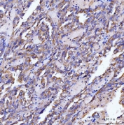IHC testing of FFPE human renal cancer tissue with SLC12A1 antibody. HIER: Boil the paraffin sections in pH8 EDTA buffer for 20 minutes and allow to cool prior to staining.