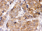 IHC testing of FFPE human breast cancer tissue with EIF4A2 antibody. HIER: Boil the paraffin sections in pH 6, 10mM citrate buffer for 20 minutes and allow to cool prior to staining.