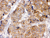 IHC testing of FFPE human breast cancer tissue with EIF4A2 antibody. HIER: Boil the paraffin sections in pH 6, 10mM citrate buffer for 20 minutes and allow to cool prior to staining.